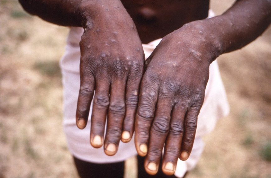 CDC warns of more severe mpox strain spreading in Central Africa