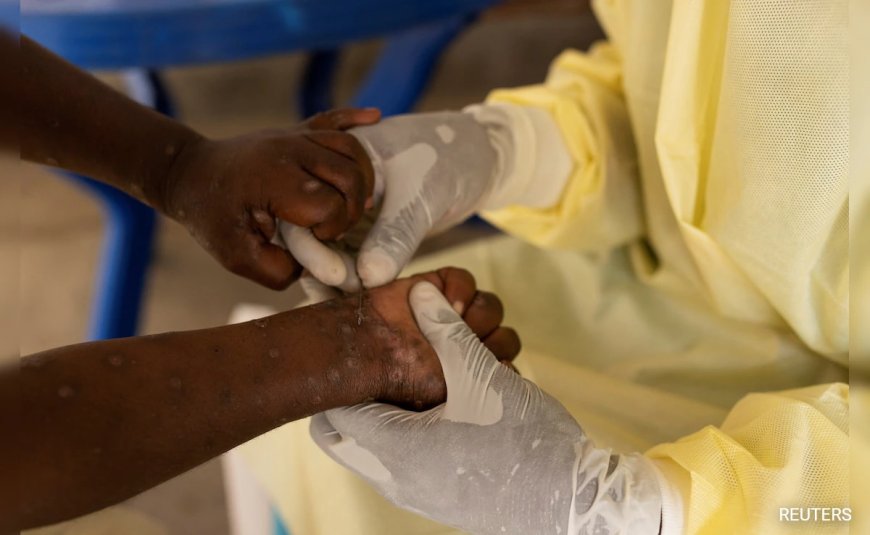 Mpox Death Count Crosses 570 As Congo Awaits Vaccines