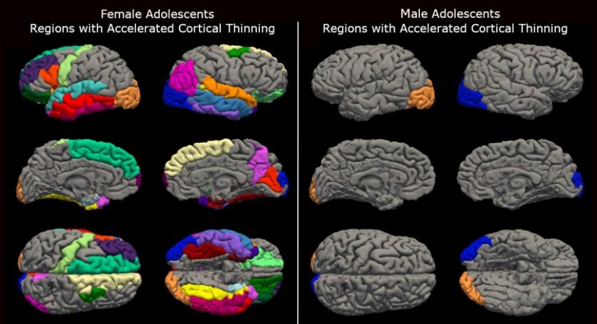 Girls' brains aged at an 'accelerated' rate during the pandemic, study finds